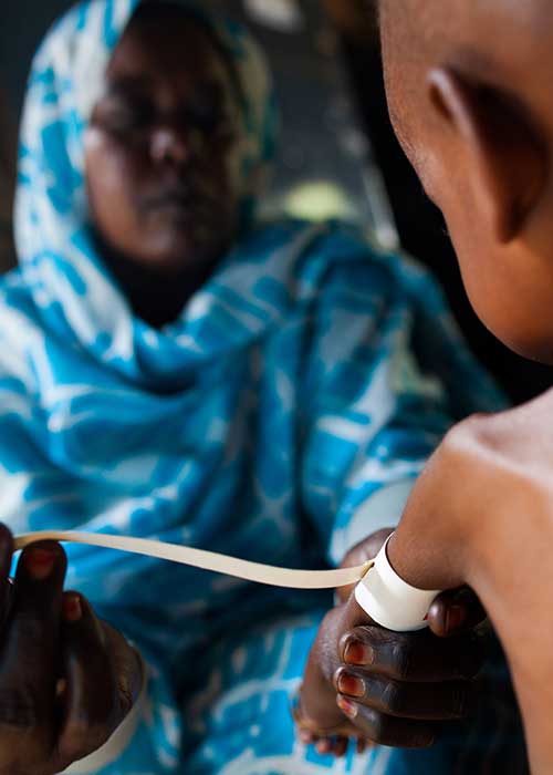 Nurse measures a childs arm with a severe malnutrition in a clinic in an IDP camp in North Darfur
